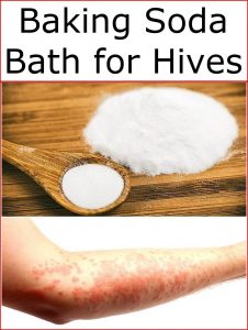 Baking Soda Bath for Hives | Baking Soda Uses and DIY Home Remedies.